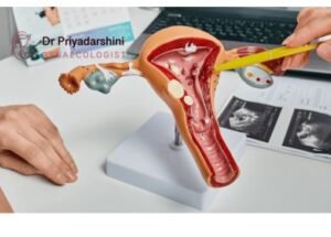 Uterine Polyps