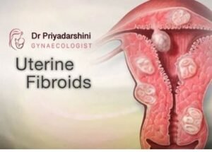 Fibroids in Women